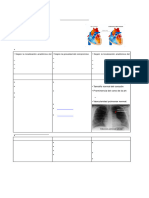 Estenosis Pulmonar