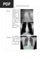 Lectura de Radiografia de Torax