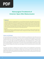 Nonsurgical Treatment of Anterior Open Bite Malocclusion