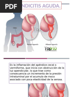 Apendicitis Aguda