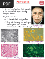 Amyloidosis