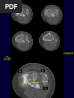 TAC MESETA TIBIAL_075339