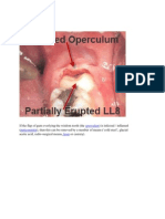 Operculectomy