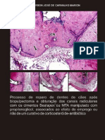 Biopulpectomia e Obturação Dos Canais