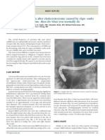 Bile Duct Obstruction After Cholecystectomy