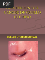 CA de Cuello Uterino