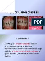 Malocclusion Class III