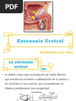 Estenosis Uretral