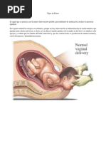 Tipos de Partos