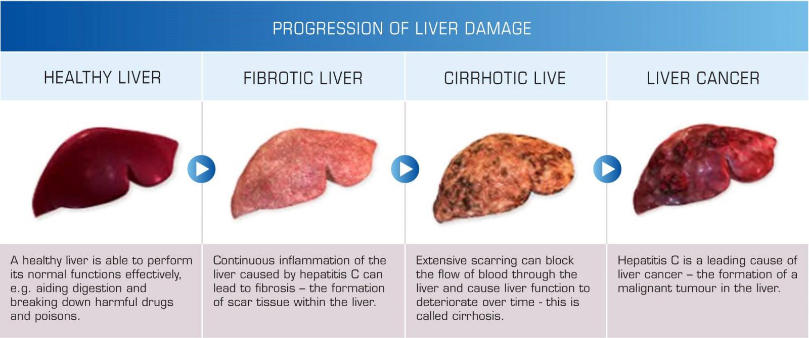 Transplantasi Liver | Indonesia Re