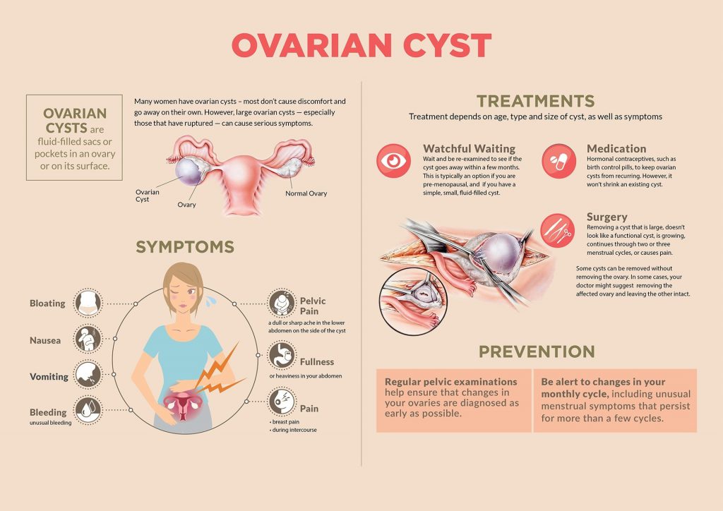 Ovarian Cyst Symptoms And Signs