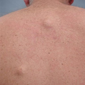 Sebaceous Cysts