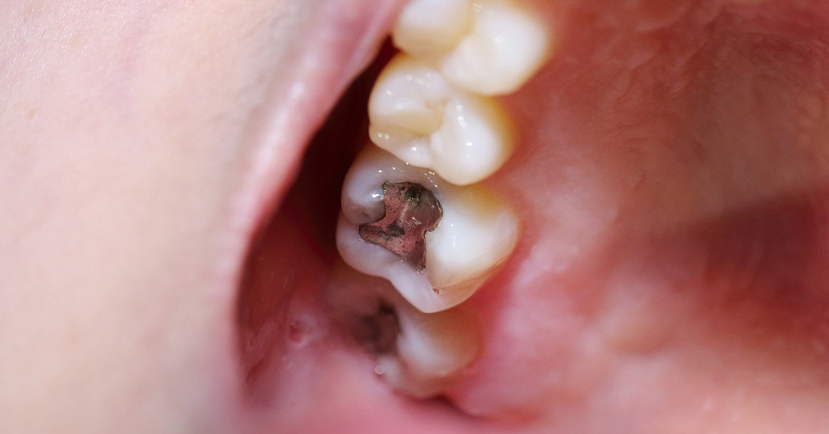 Small Cavity Side Of Tooth