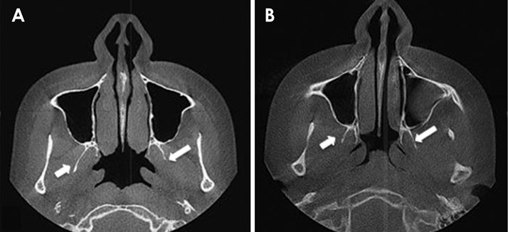 Can pterygoid plate asymmetry be linked to temporomandibular joint ...