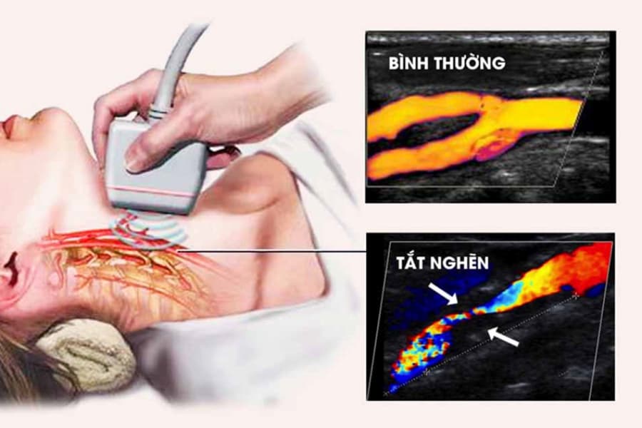 Hẹp động mạch cảnh trên siêu âm do mảng xơ vữa / huyết khối