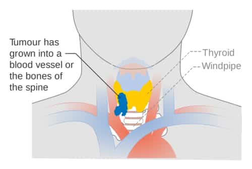 thyroid cancer