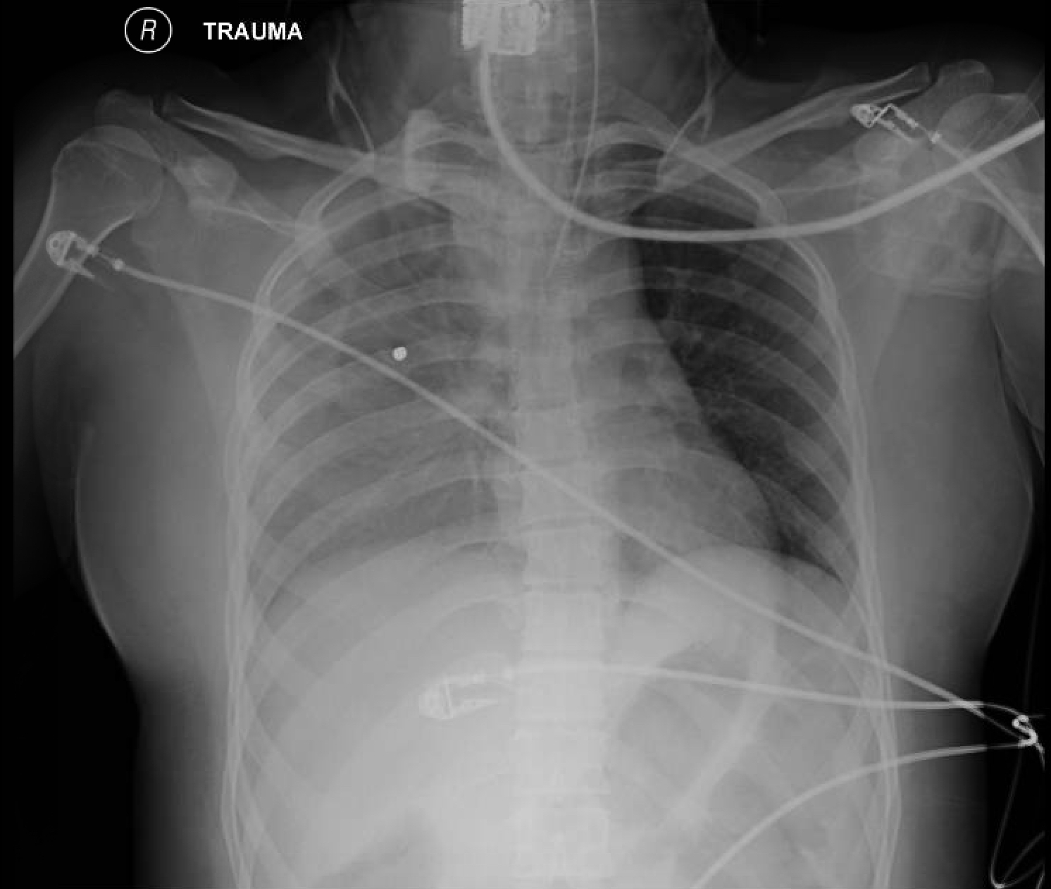 Chest X Ray Hemothorax