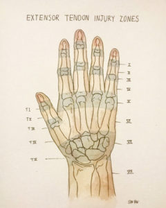 Zones Of Extensor Tendon Injury