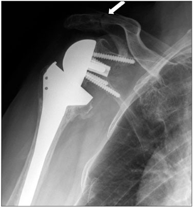 Acromion Fracture after Reverse Total Shoulder Arthroplasty