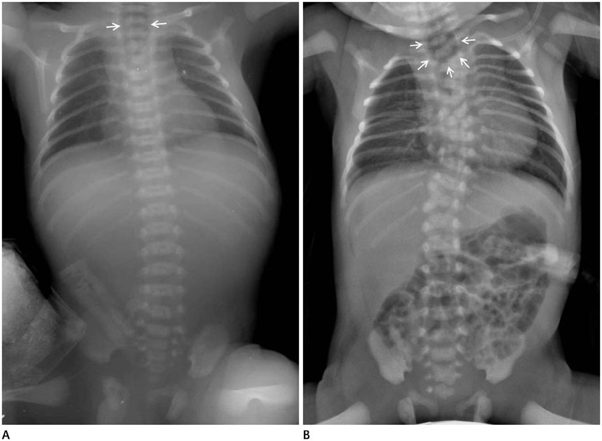 Normal Child Chest X Ray