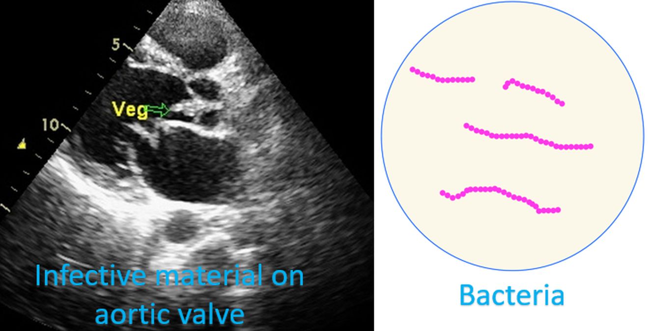 Infective Endocarditis Echo