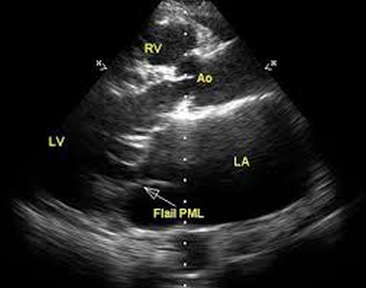 Mitral Valve Posterior Leaflet