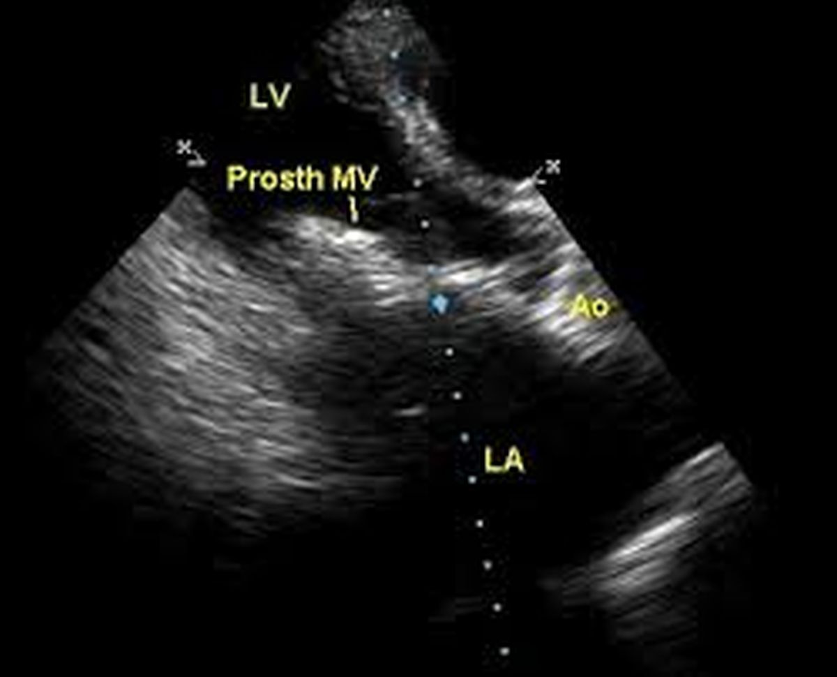 Prosthetic mitral valve echocardiogram – All About Cardiovascular ...