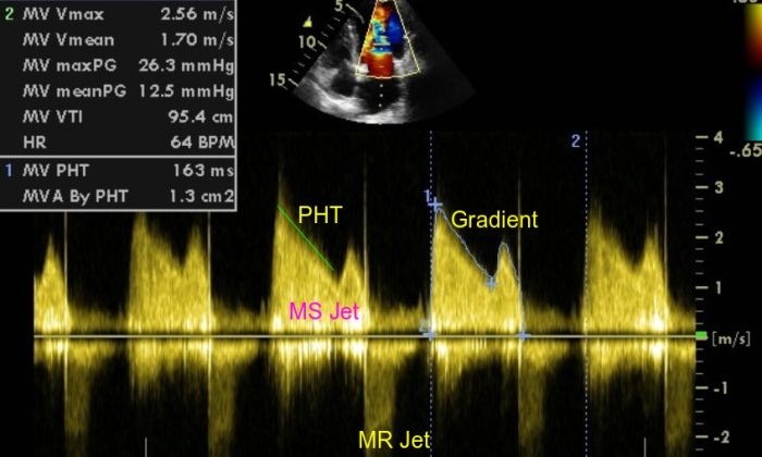 Normal Mitral Valve Echo