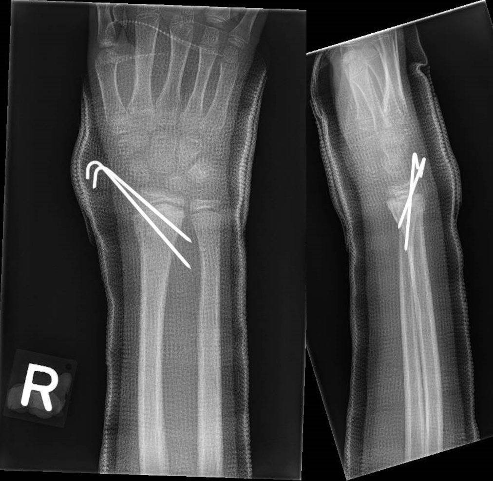 Displaced paediatric distal radius fractures with volar skin tenting