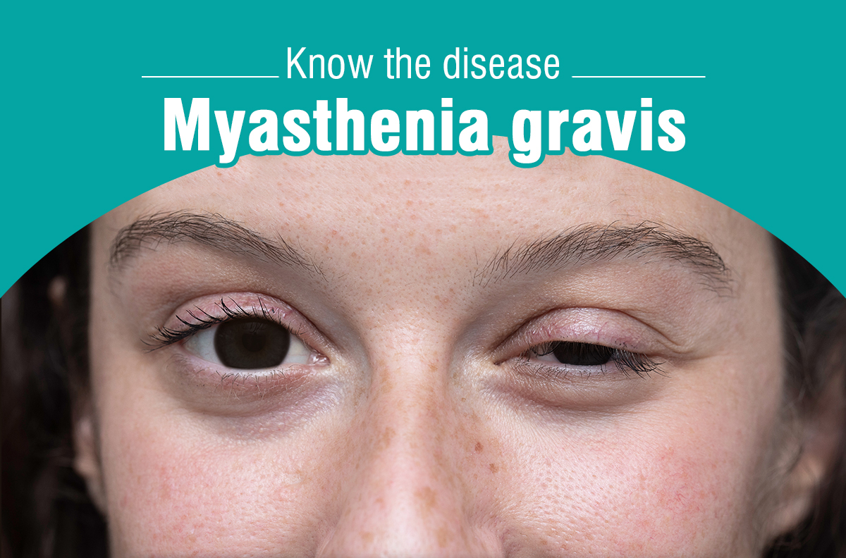 Ocular Myasthenia Gravis Symptoms