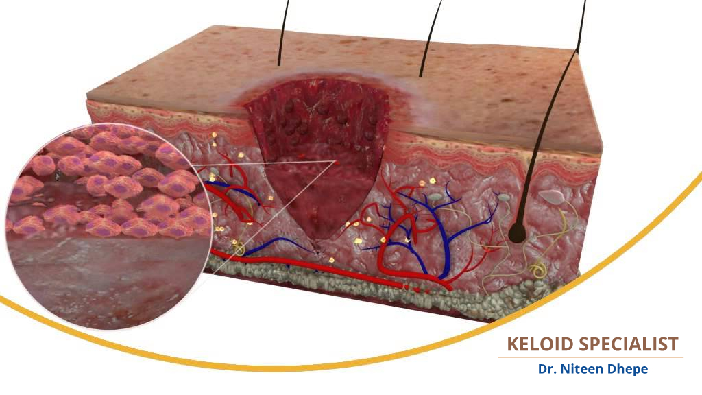 keloid wound