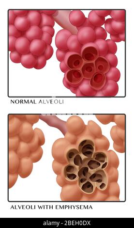 Illustration comparing the appearance of normal alveoli (left) with ...