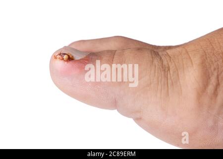 Closeup of inflammation and blood associated with painful ingrown toenail Stock Photo