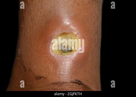 Diabetic ulcer in leg of Asian. patient. Poor wound healing. Isolated on black. Stock Photo