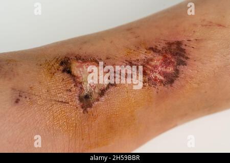 wound on the leg, Injuries from falling Stock Photo