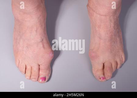 foot diseases close-up of an elderly woman on a gray background Stock Photo