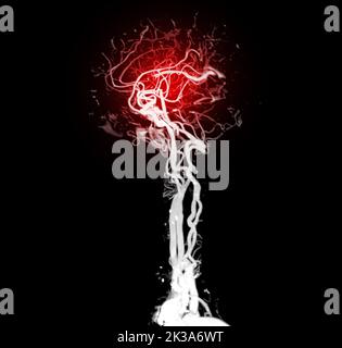 CTA brain or CT angiography of the brain  3D Rendering image for diagnosis cerebral artery aneurysm. Stock Photo