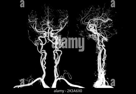 CTA brain or CT angiography of the brain  3D Rendering image for diagnosis cerebral artery aneurysm. Stock Photo