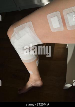 A close-up of a human leg after varicose vein surgery using the newest generation varicose vein laser. Vein laser surgery is one of the most modern an Stock Photo