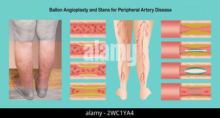 Diagram showing angioplasty for peripheral artery disease illustration. Concept of dry skin, old senior people, varicose veins and DVT . Stock Photo