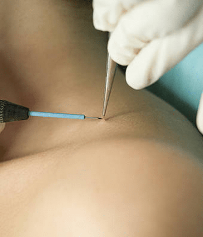 Skin Tag Removal