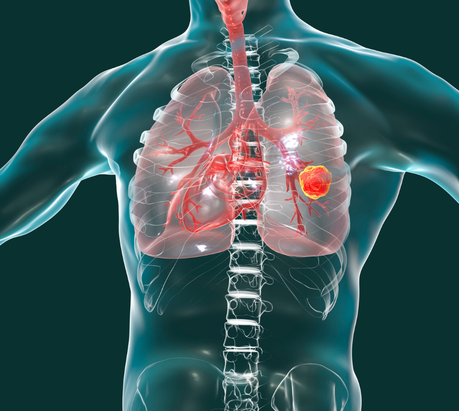 Non-Small Cell Lung Cancer - What You Need to Know | LCFA