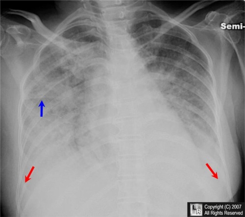 Learning Radiology - Congestive Heart Failure, Pulmonary Edema