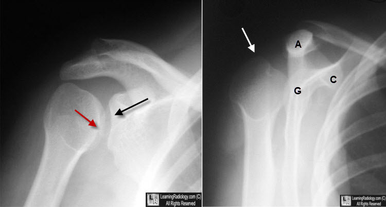 X Ray Shoulder Dislocation