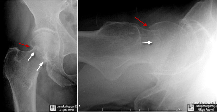 Subcapital Femoral Neck Fracture