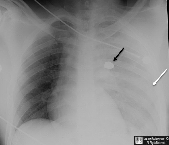 Left Hemothorax X Ray