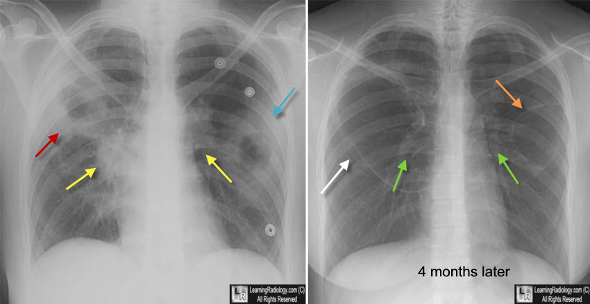 LearningRadiology - Granulomatosis, PolyangiitiS, GPA, Wegener's