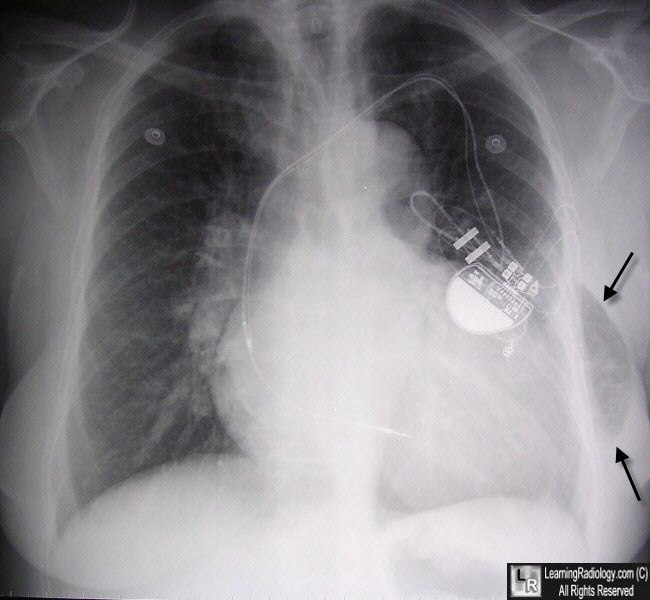 Learning Radiology - lung, hernia