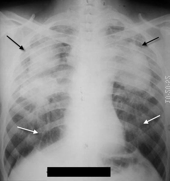 LearningRadiology - Silicosis, PMF, progressive, massive, fibrosis