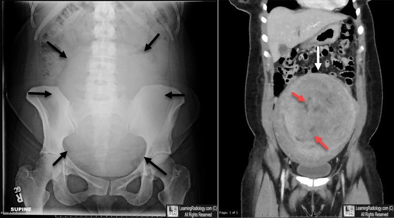 Uterine Fibroids Xray